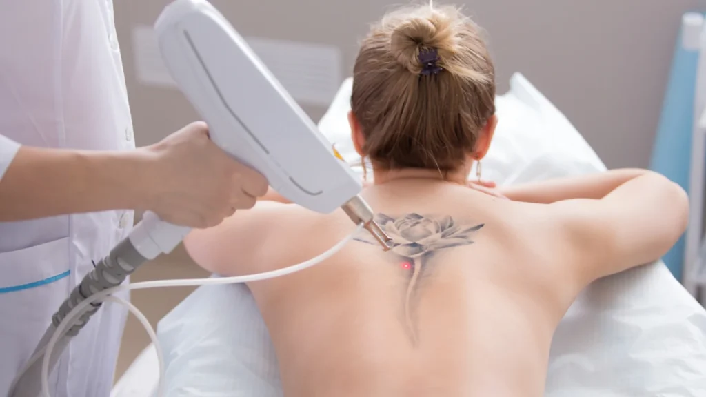 Laser Tattoo Removal in Texas